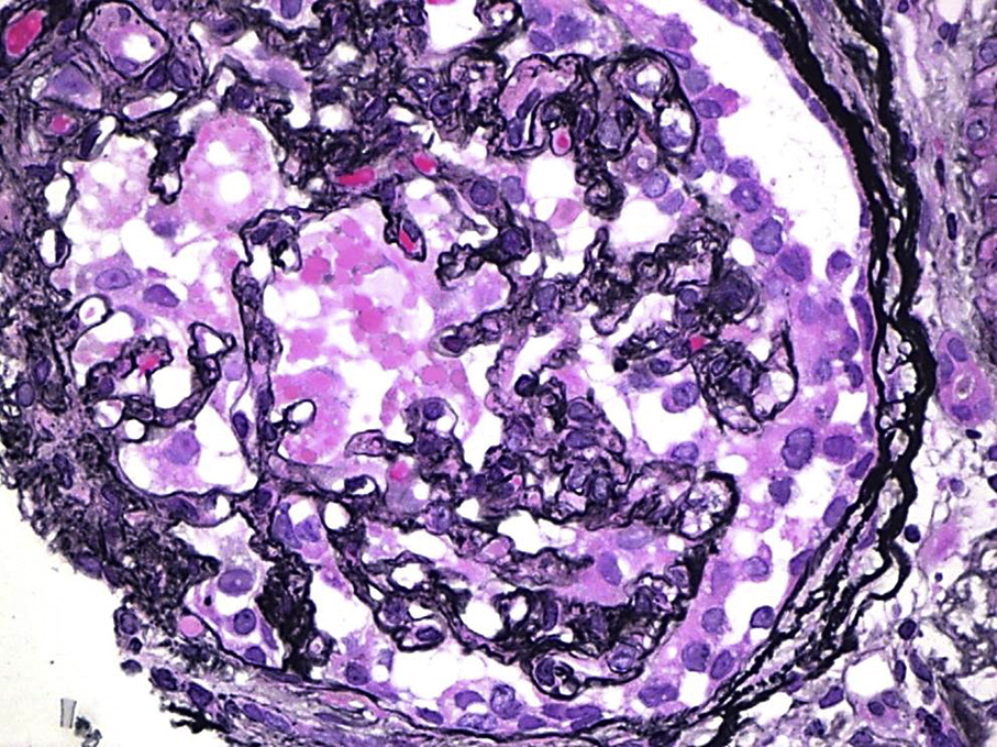 Atlas Fogo等人的塌陷性肾小球病