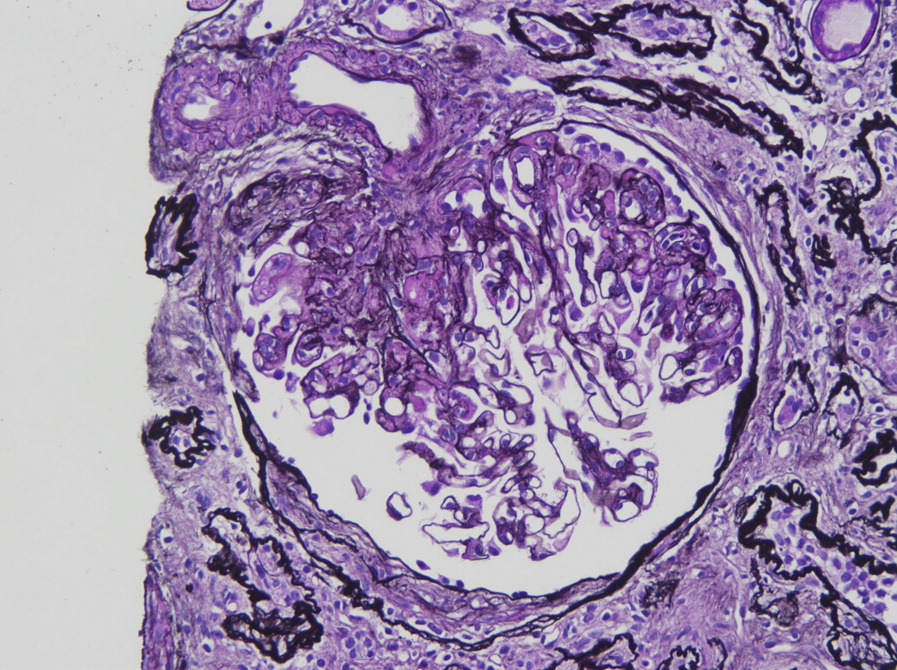 图1寰椎门区FSGS变异